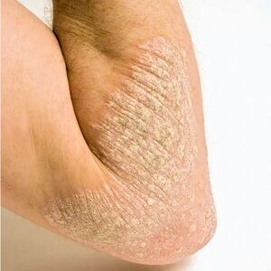 Body foam for psoriasis